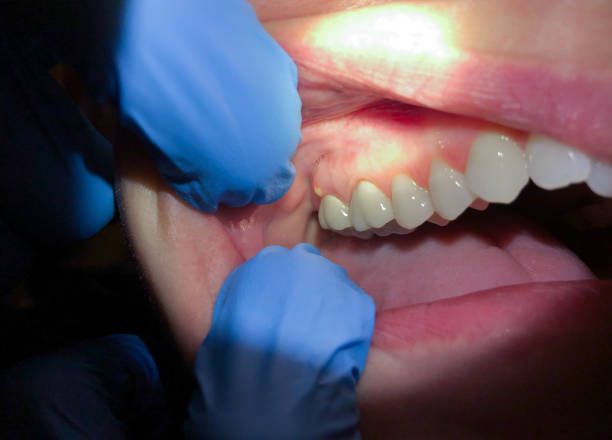 Best Emergency Tooth Extraction in Macon, MO