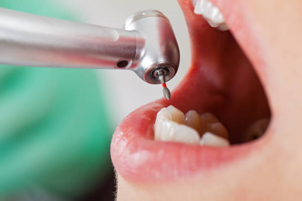 Best Emergency Tooth Extraction in Macon, MO